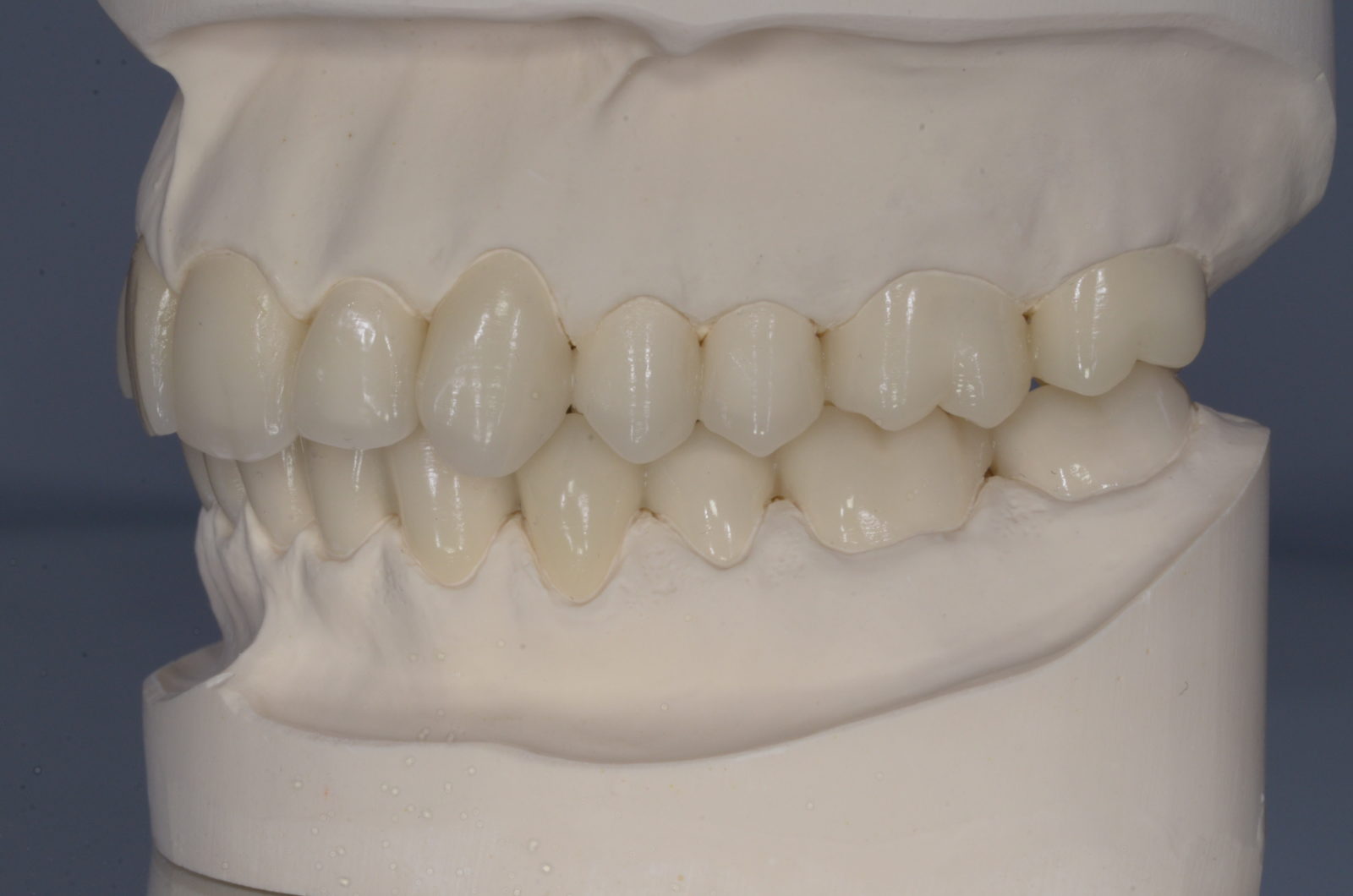 Provisorien - Dental Studio München